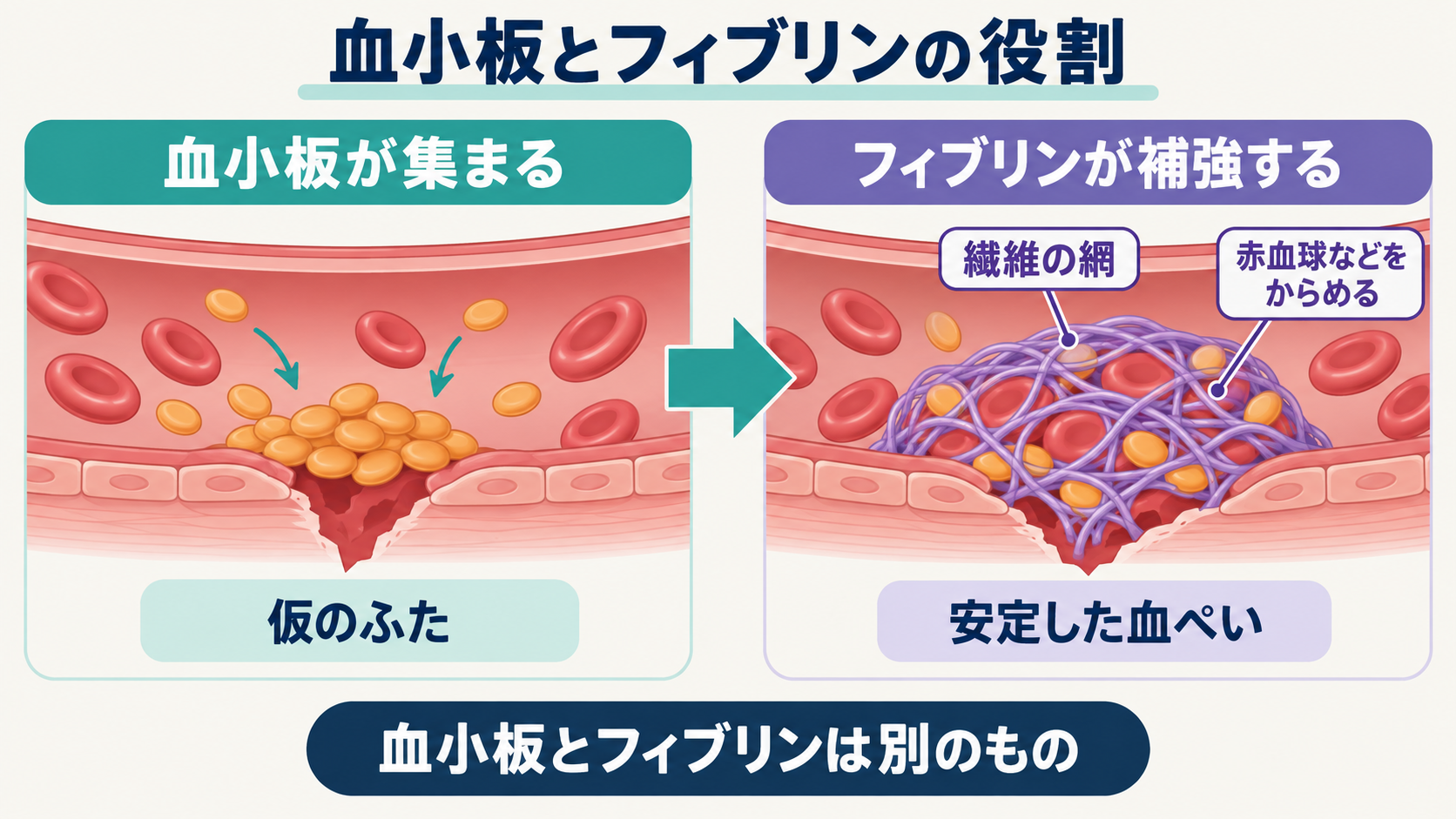 傷ついた血管に集まった血小板をフィブリンの網が補強し、赤血球などをからめて血ぺいをつくる様子を拡大した図